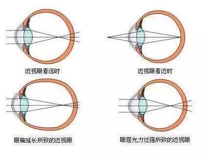 “小孩视力以前挺好的，没想到一个寒假下来就近视了。”昨天的金沙澳门(中国)唯一官方网站小儿眼科门诊里，很多家长都反应说，“孩子期末成绩不错，所以假期里对他的管束放松了，一有空就拿起手机玩。直到前几天，他嚷着看东西变模糊了，才带孩子来医院检查，检查结果是左右眼出现不同程度的近视，医生建议配戴眼镜。.jpg