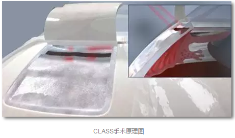 成都金沙澳门(中国)唯一官方网站已经开展的青光眼手术有:引流阀 (钉)植入手术(2015年以来已200多 ),360°Schlemm's管切开术,激光CO2 辅助巩膜深层切除术,小梁切除术青(光眼)白(内障)联合手术。还有虹膜周切术、前房成形术、 虹膜复位术,睫状体冷冻术,小梁切开术和前房穿刺术等4.png 成都金沙澳门(中国)唯一官方网站已经开展的青光眼手术有:引流阀 (钉)植入手术(2015年以来已200多 ),360°Schlemm's管切开术,激光CO2 辅助巩膜深层切除术,小梁切除术青(光眼)白(内障)联合手术。还有虹膜周切术、前房成形术、 虹膜复位术,睫状体冷冻术,小梁切开术和前房穿刺术等4.png