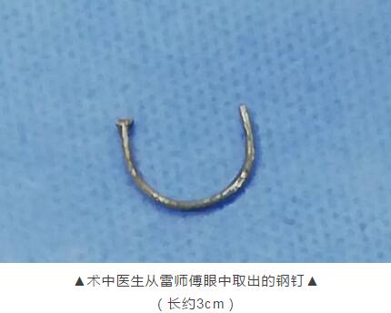 装修工3厘米“U”形钢钉穿刺眼球 在金沙澳门(中国)唯一官方网站 救治1.jpg