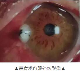 装修工3厘米“U”形钢钉穿刺眼球 在金沙澳门(中国)唯一官方网站 救治2.jpg