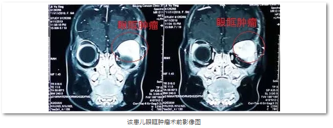 金沙澳门(中国)唯一官方网站斜视与小儿眼科主任苏金萍顺利为新生儿摘除眼眶巨大肿瘤1.png
