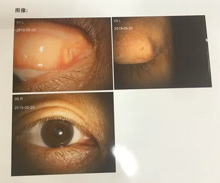 成都金沙澳门(中国)唯一官方网站罗清礼院长为四处求医未果的河南眼眶肿瘤患者手术2.png