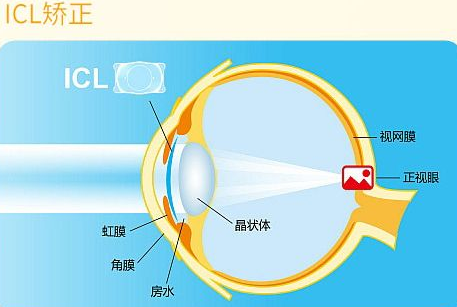 近视无法根治?但你可以这样做?金沙澳门(中国)唯一官方网站“有爱就有希望”近视手术火热进行中8.png 近视无法根治?但你可以这样做?金沙澳门(中国)唯一官方网站“有爱就有希望”近视手术火热进行中8.png